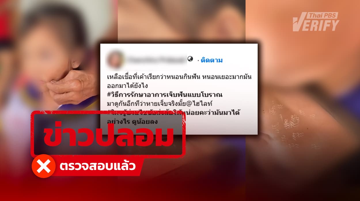 ไม่มีจริง ! Thai PBS Verify ตรวจสอบคลิปอ้าง หมอพื้นบ้านป้ายยาแก้ปวดฟัน ทำ “หนอนกินฟัน” หลุดออกกระพุ้งแก้ม